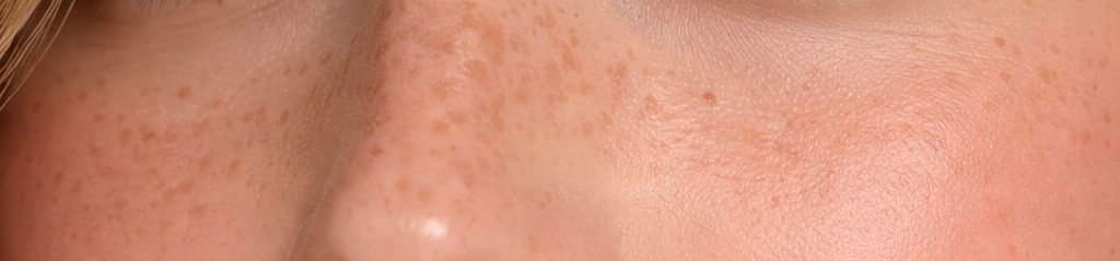 Sunkissed Freckles